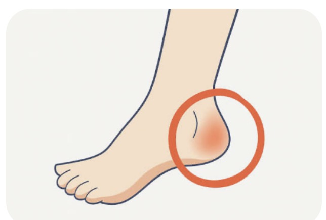 朝の一歩目にかかとが痛いのはなぜ？足裏の痛みと足底腱膜炎